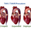 TAVI / TAVR Procudure