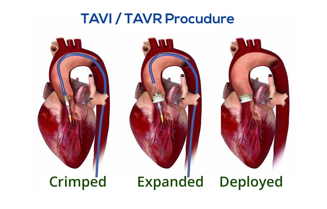 TAVI / TAVR Procudure