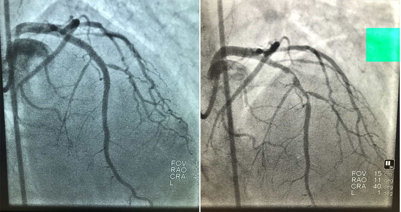 Coronary Angiogram & Angioplasty