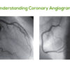 Coronary Angiogram In Kolkata