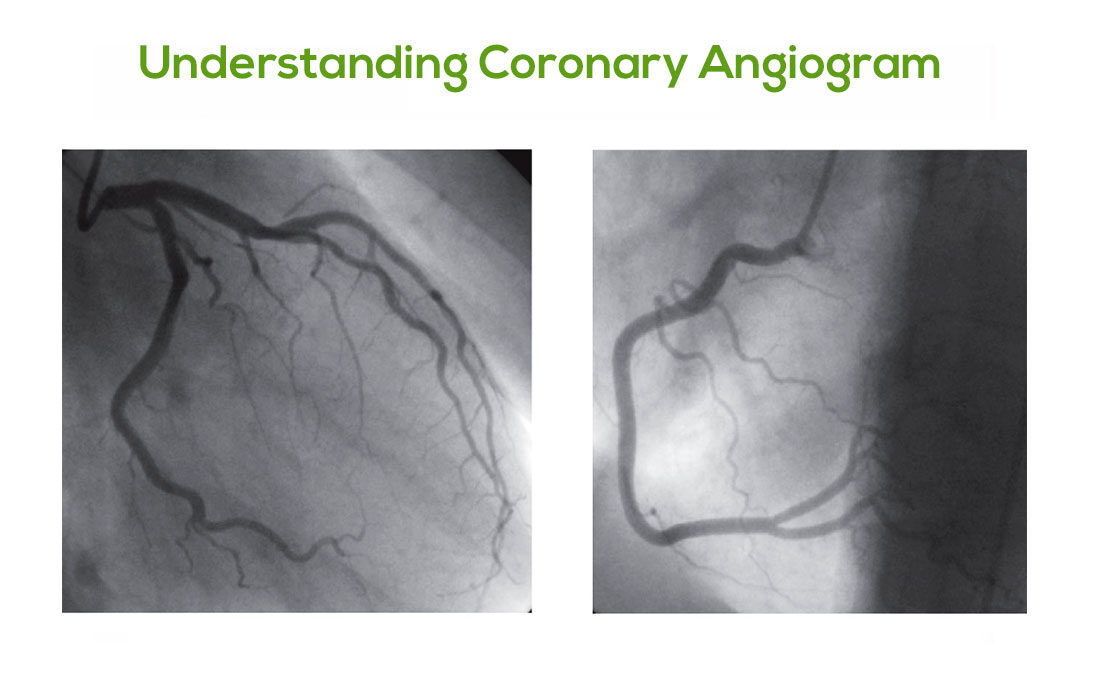 Coronary Angiogram In Kolkata