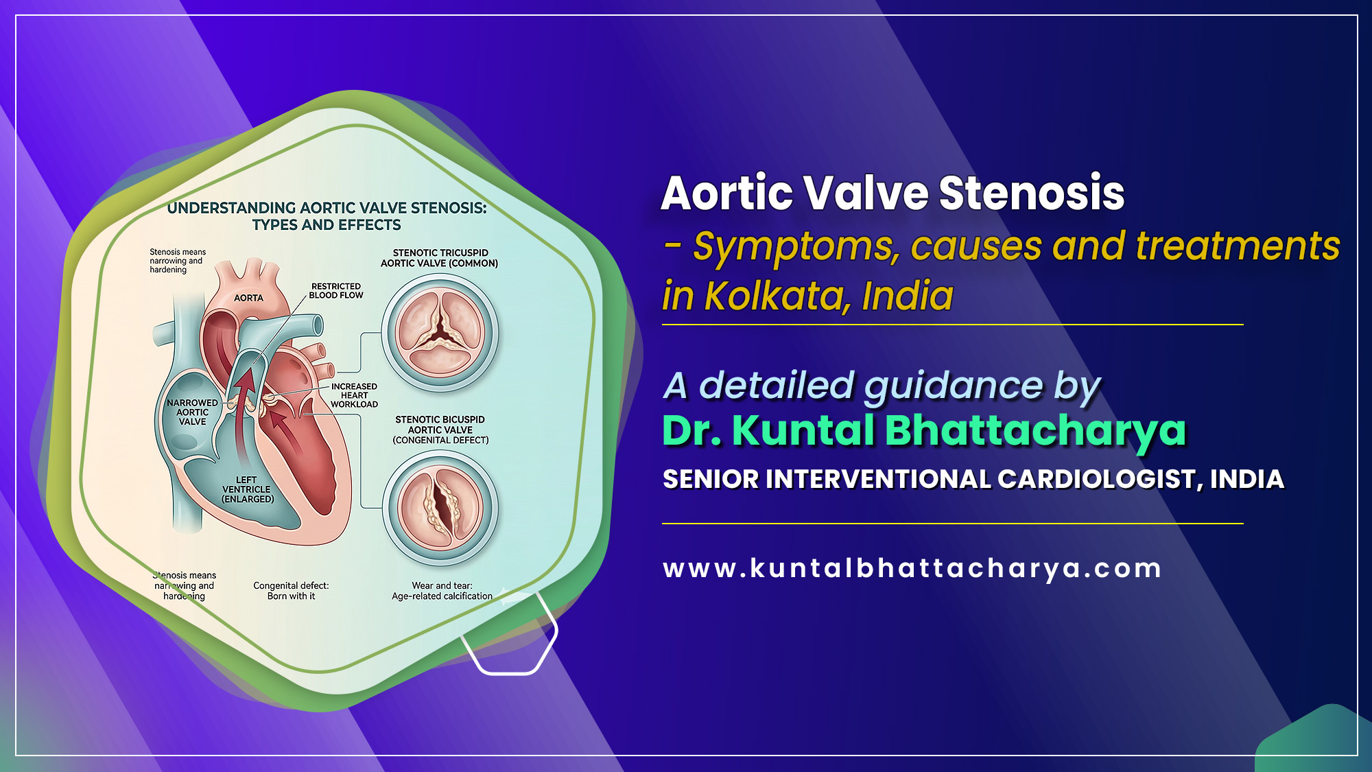 ‘Aortic valve stenosis - Symptoms, causes and treatments in Kolkata, India’ – a detailed guide by Dr. Kuntal Bhattacharya Senior Interventional Cardiologist, Narayana Health RN Tagore Hospital, Kolkata