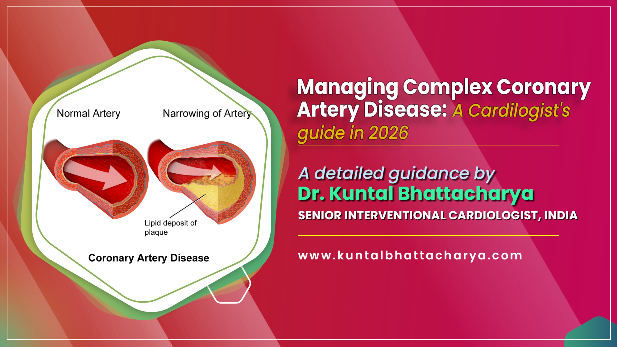 A comprehensive guide on ‘Managing Complex Coronary Artery Disease in 2026: A Cardiologist’s Guide’ – by Dr. Kuntal Bhattacharya Senior Interventional Cardiologist, Narayana Health – RN Tagore Hospital, Kolkata