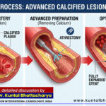 ‘What is a Calcified Lesion? Advanced Solutions for Hardened Arteries’ – a detailed guide by Dr. Kuntal Bhattacharya, Senior Interventional Cardiologist, Narayana Health – RN Tagore Hospital, Kolkata