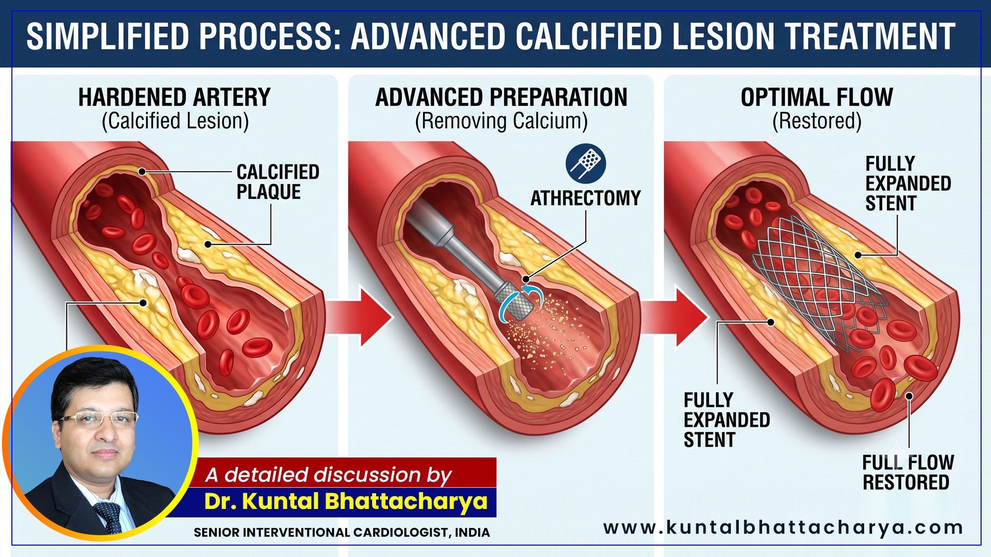 ‘What is a Calcified Lesion? Advanced Solutions for Hardened Arteries’ – a detailed guide by Dr. Kuntal Bhattacharya, Senior Interventional Cardiologist, Narayana Health – RN Tagore Hospital, Kolkata